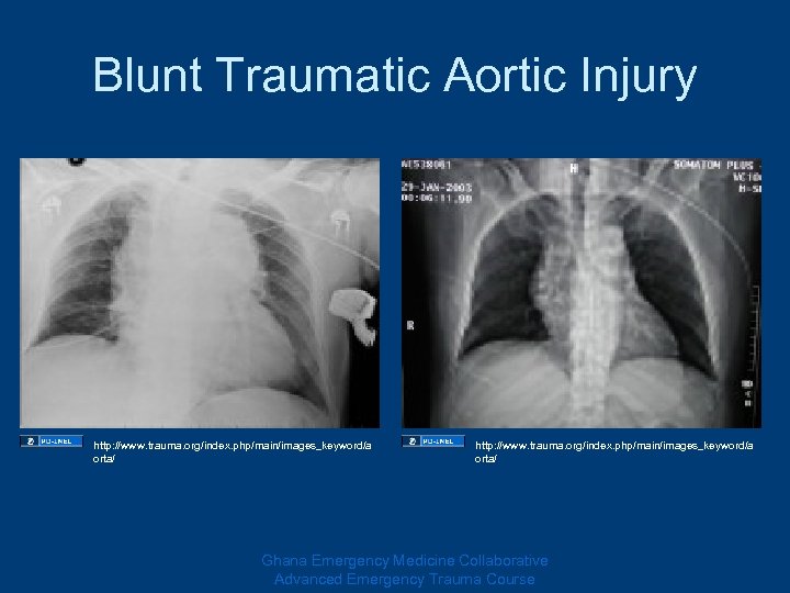 Blunt Traumatic Aortic Injury http: //www. trauma. org/index. php/main/images_keyword/a orta/ Ghana Emergency Medicine Collaborative