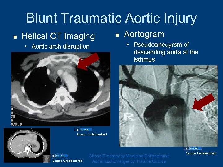 Blunt Traumatic Aortic Injury n Helical CT Imaging • Aortic arch disruption n Aortogram