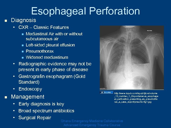Esophageal Perforation n Diagnosis • CXR – Classic Features n n Mediastinal Air with