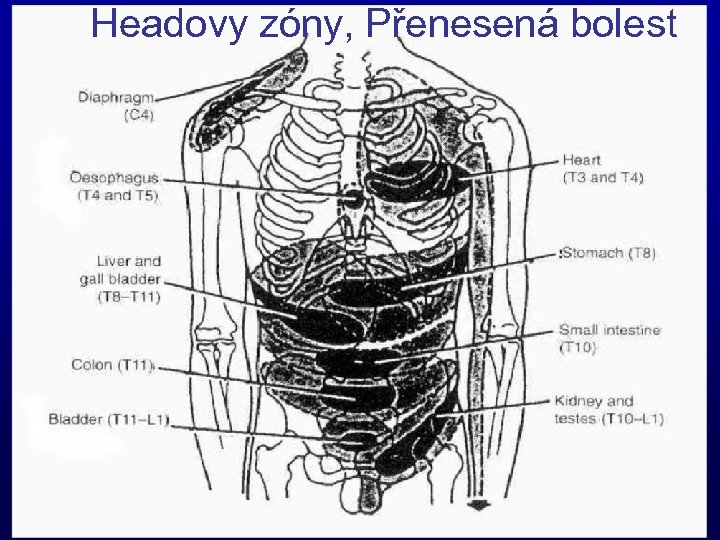 Headovy zóny, Přenesená bolest 57 