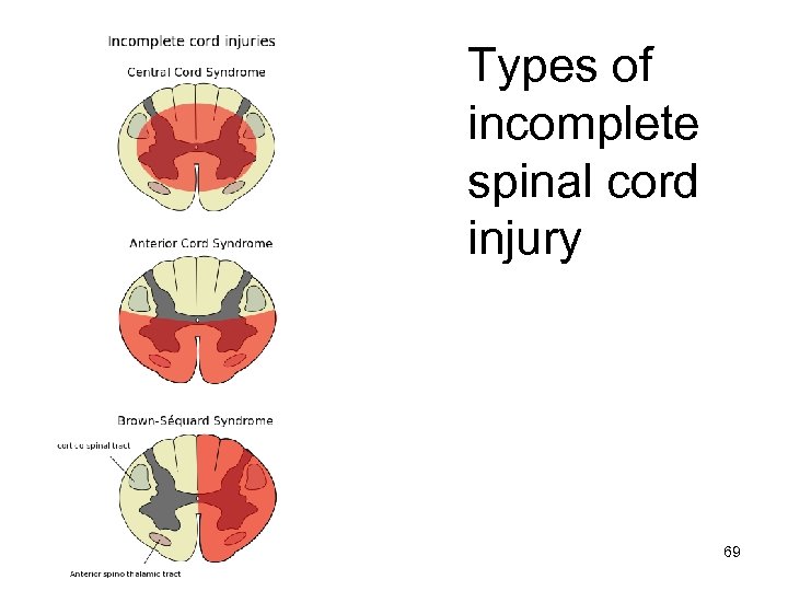 Types of incomplete spinal cord injury 69 