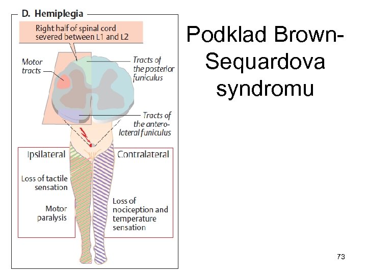 Podklad Brown. Sequardova syndromu 73 