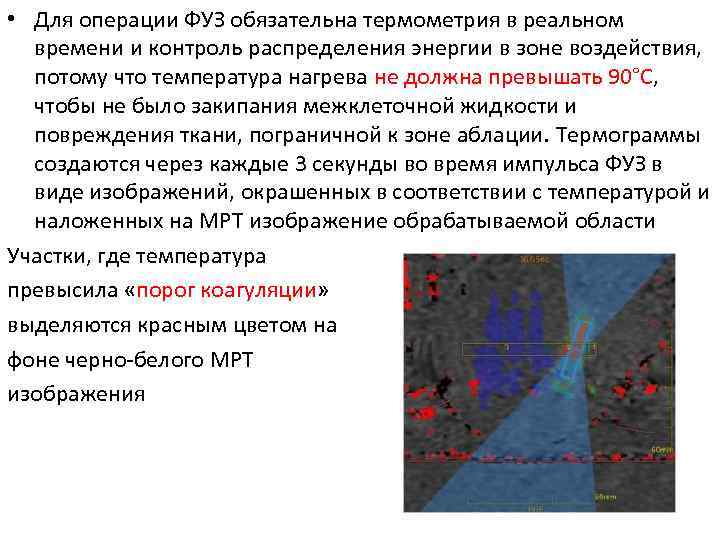  • Для операции ФУЗ обязательна термометрия в реальном времени и контроль распределения энергии