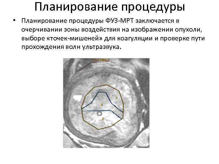 Планирование процедуры • Планирование процедуры ФУЗ-МРТ заключается в очерчивании зоны воздействия на изображении опухоли,