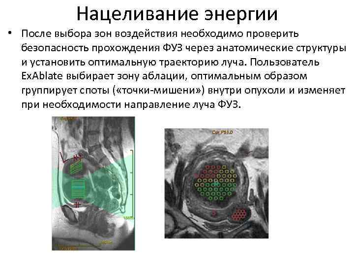 Нацеливание энергии • После выбора зон воздействия необходимо проверить безопасность прохождения ФУЗ через анатомические