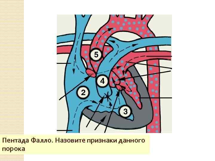 Пентада Фалло. Назовите признаки данного порока 