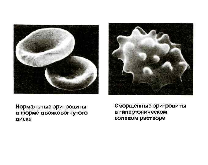 Нормальные эритроциты в форме двояковогнутого диска Сморщенные эритроциты в гипертоническом солевом растворе 
