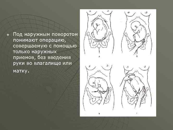 u Под наружным поворотом понимают операцию, совершаемую с помощью только наружных приемов, без введения