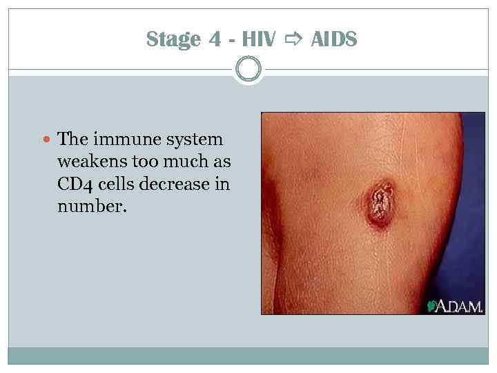 Stage 4 - HIV AIDS The immune system weakens too much as CD 4