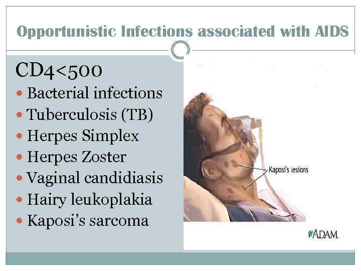 Opportunistic Infections associated with AIDS CD 4<500 Bacterial infections Tuberculosis (TB) Herpes Simplex Herpes