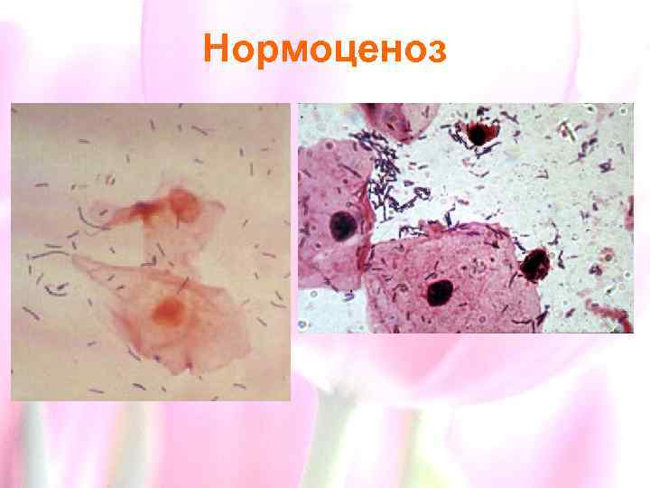 Нормоценоз 