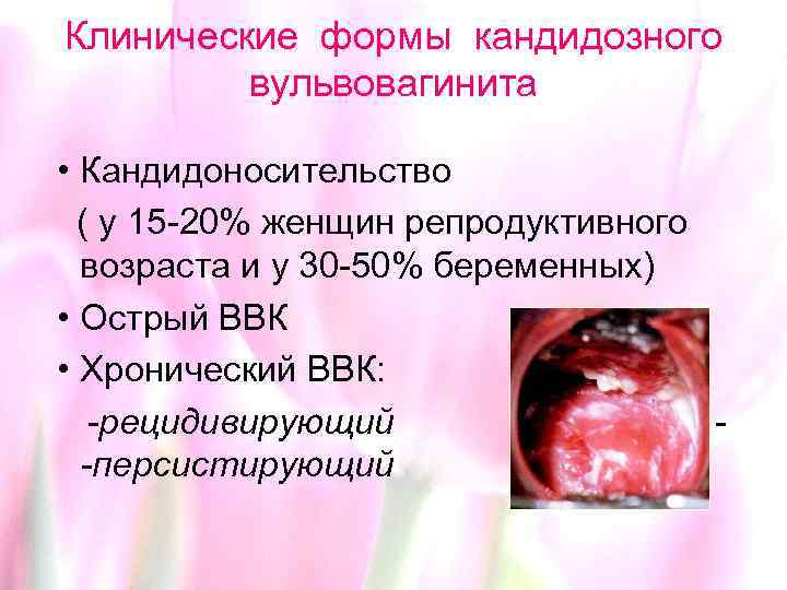 Клинические формы кандидозного вульвовагинита • Кандидоносительство ( у 15 -20% женщин репродуктивного возраста и