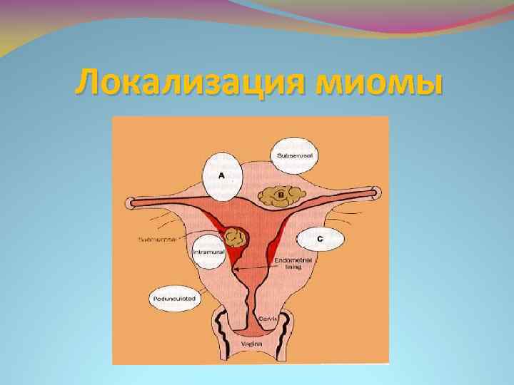 Локализация миомы 