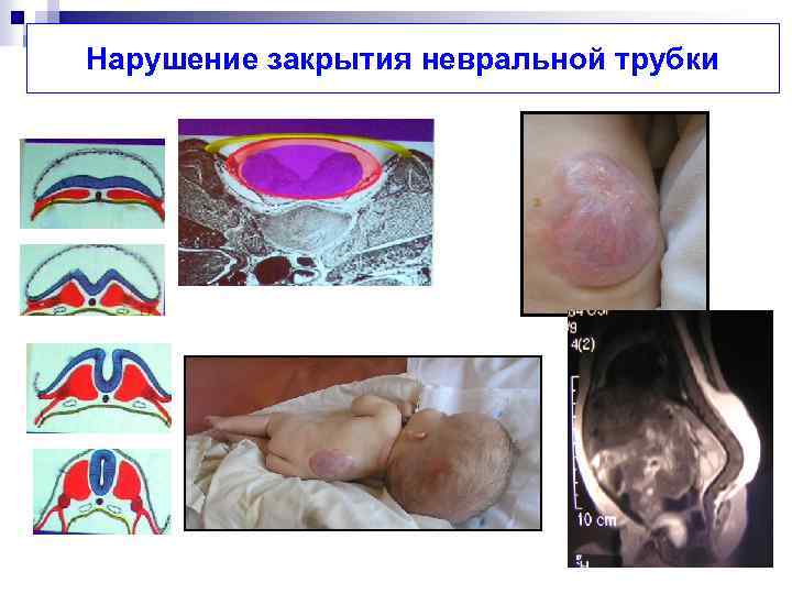 Нарушение закрытия невральной трубки 