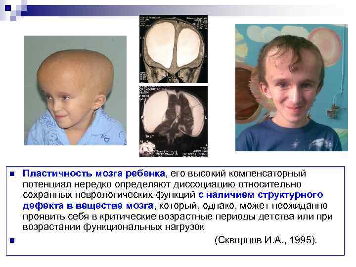 n n Пластичность мозга ребенка, его высокий компенсаторный потенциал нередко определяют диссоциацию относительно сохранных