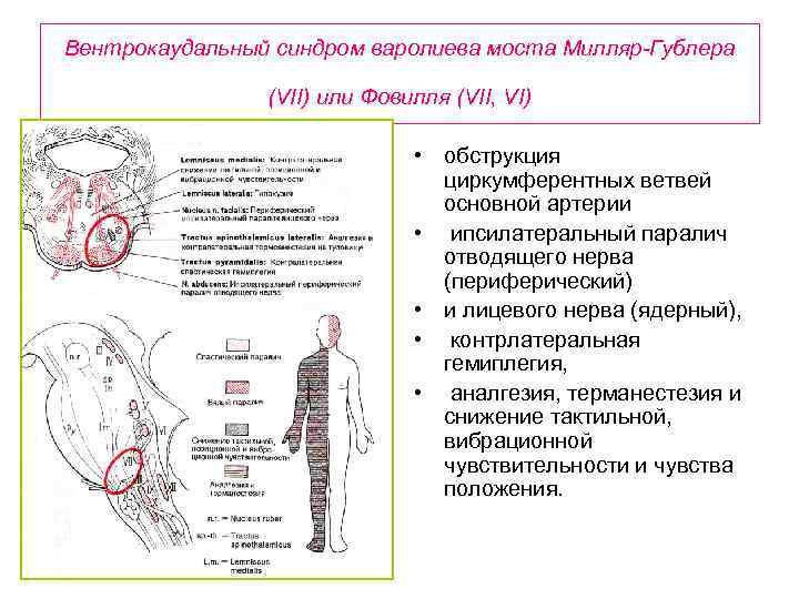 Альтернирующие синдромы схема