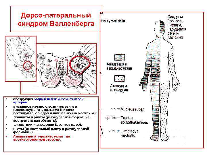 Дорсо-латеральный синдром Валленберга • • • обструкция задней нижней мозжечковой артерии внезапное начало с