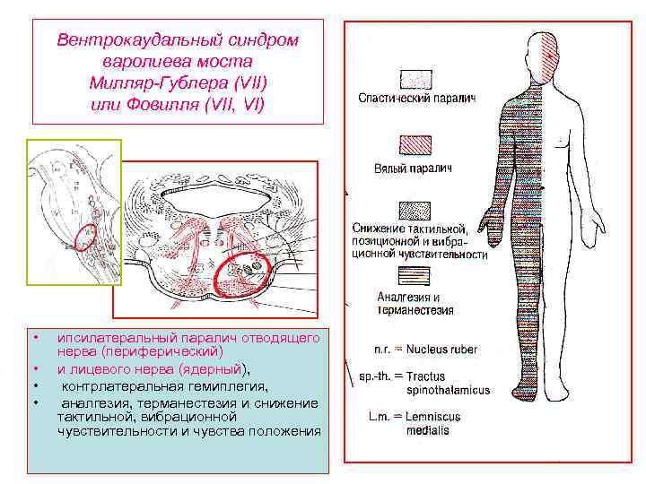 Вентрокаудальный синдром варолиева моста Милляр-Гублера (VII) или Фовилля (VII, VI) • • ипсилатеральный паралич