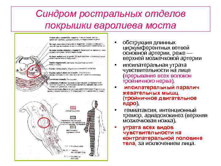 Альтернирующие синдромы схема