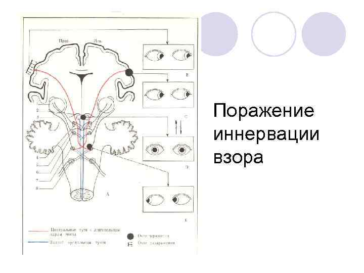 Поражение иннервации взора 