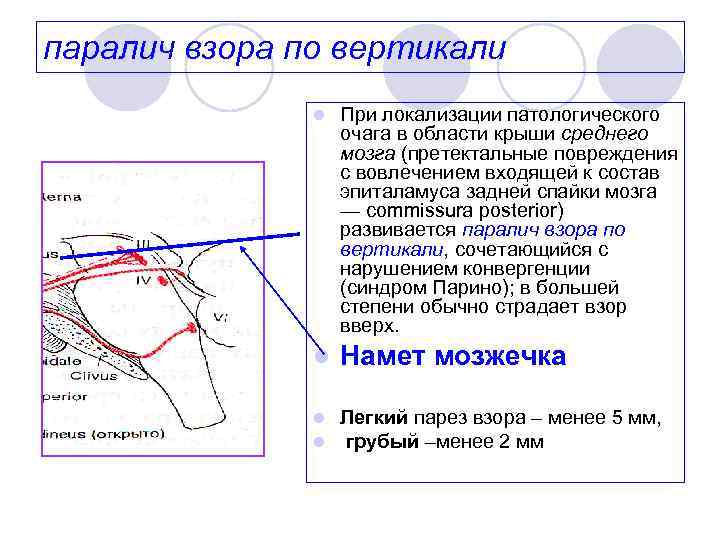 паралич взора по вертикали l При локализации патологического очага в области крыши среднего мозга