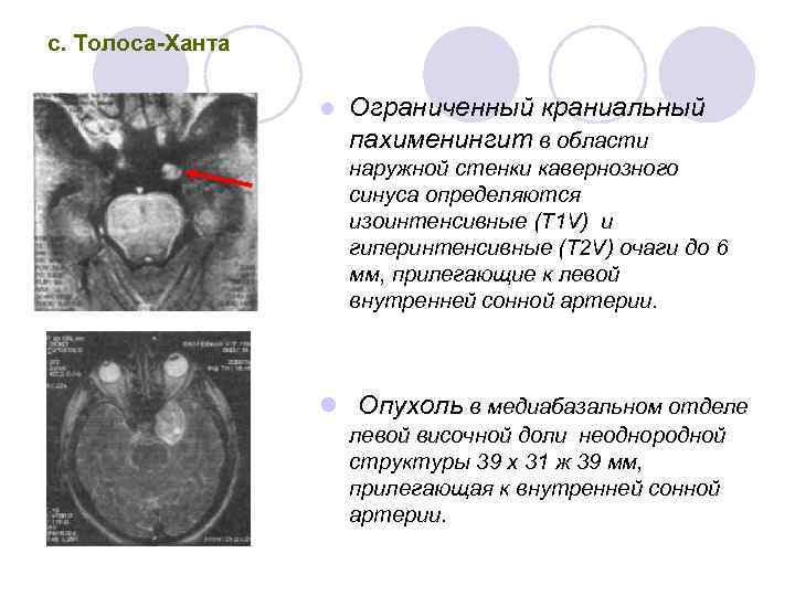 с. Толоса Ханта l Ограниченный краниальный пахименингит в области наружной стенки кавернозного синуса определяются