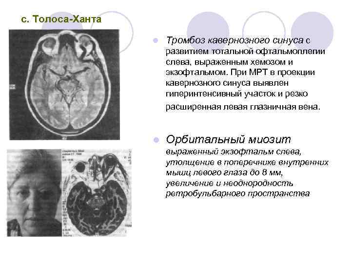 Тромбоз кавернозного синуса презентация