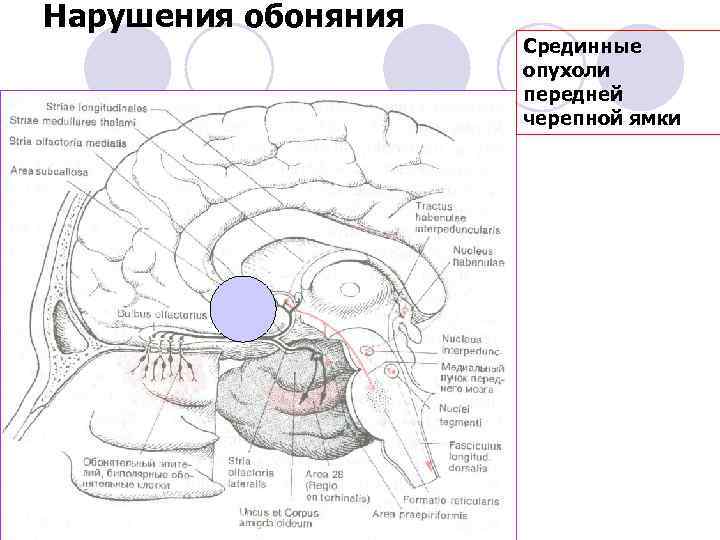 Нарушения обоняния Срединные опухоли передней черепной ямки 