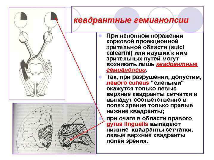 квадрантные гемианопсии При неполном поражении корковой проекционной зрительной области (sulci calcarini) или идущих к