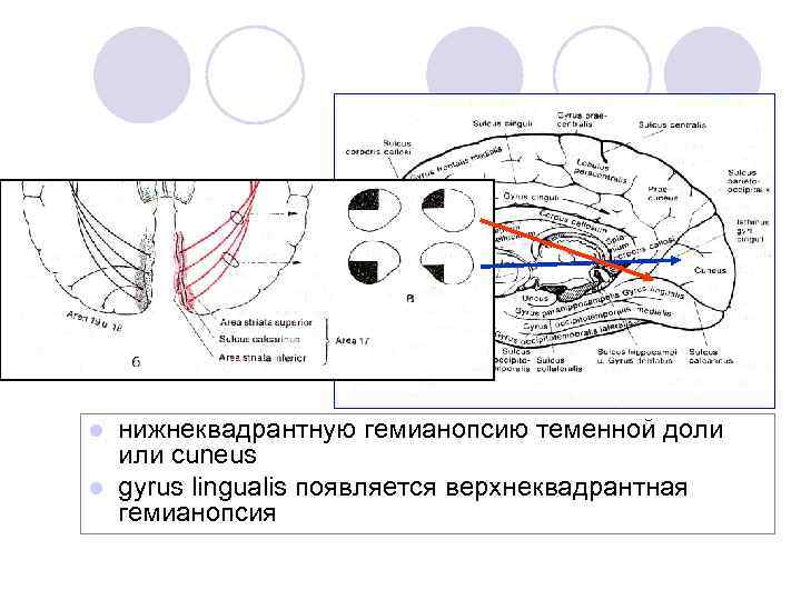 нижнеквадрантную гемианопсию теменной доли или cuneus l gyrus lingualis появляется верхнеквадрантная гемианопсия l 