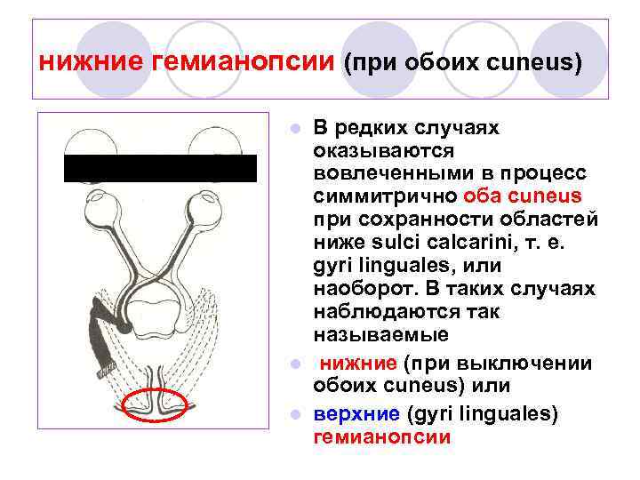 нижние гемианопсии (при обоих cuneus) В редких случаях оказываются вовлеченными в процесс симмитрично оба