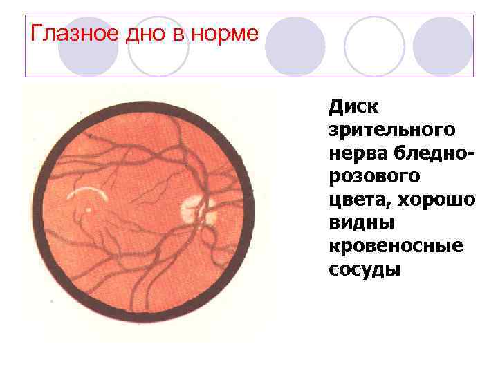 Глазное дно в норме Диск зрительного нерва бледнорозового цвета, хорошо видны кровеносные сосуды 