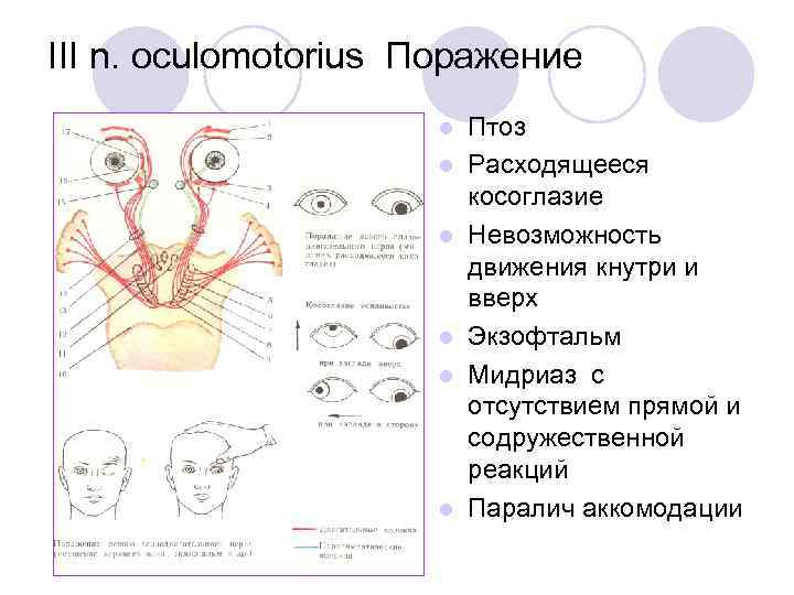 III n. oculomotorius Поражение l l l Птоз Расходящееся косоглазие Невозможность движения кнутри и