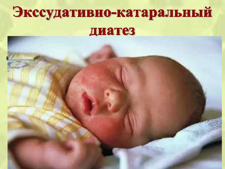 Клиника Кожные проявления 