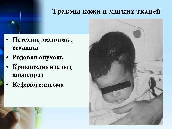 Травмы кожи и мягких тканей • Петехии, экхимозы, ссадины • Родовая опухоль • Кровоизлияние