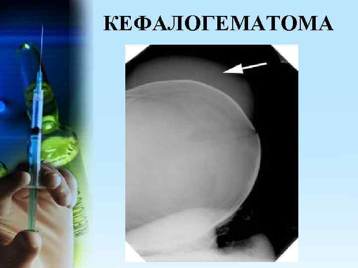 КЕФАЛОГЕМАТОМА 