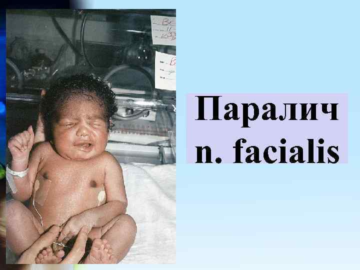 Паралич n. facialis 