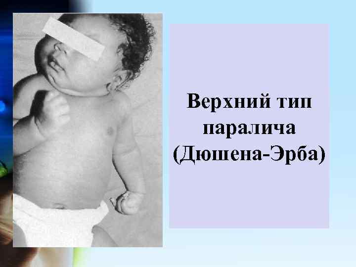 Верхний тип паралича (Дюшена-Эрба) 