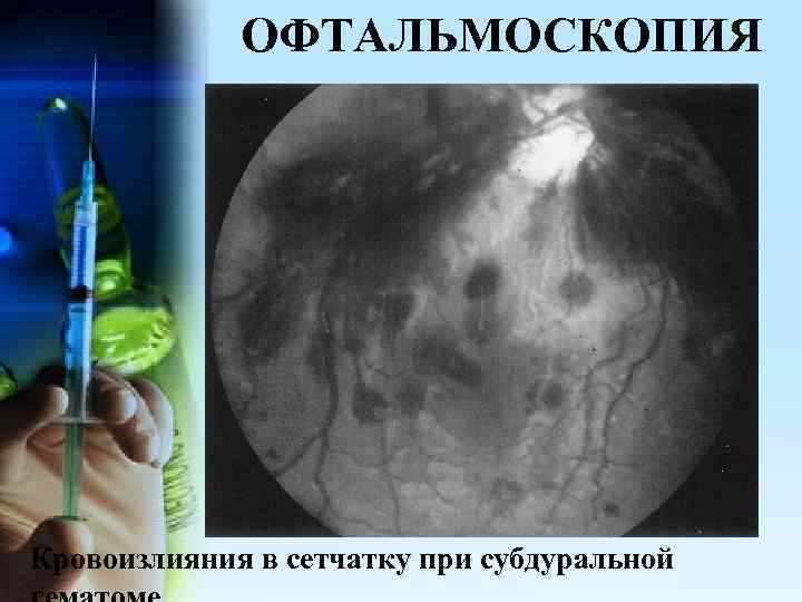 ОФТАЛЬМОСКОПИЯ Кровоизлияния в сетчатку при субдуральной 