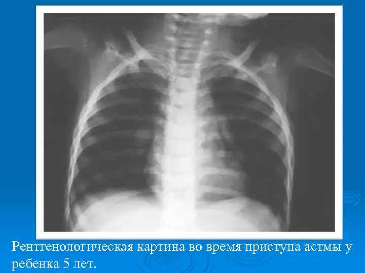 Рентгенологическая картина во время приступа астмы у ребенка 5 лет. 