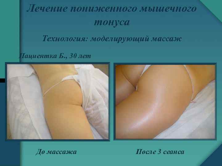 Лечение пониженного мышечного тонуса Технология: моделирующий массаж Пациентка Б. , 30 лет До массажа