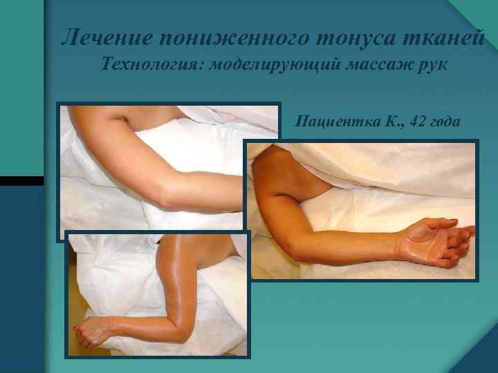 Лечение пониженного тонуса тканей Технология: моделирующий массаж рук Пациентка К. , 42 года 