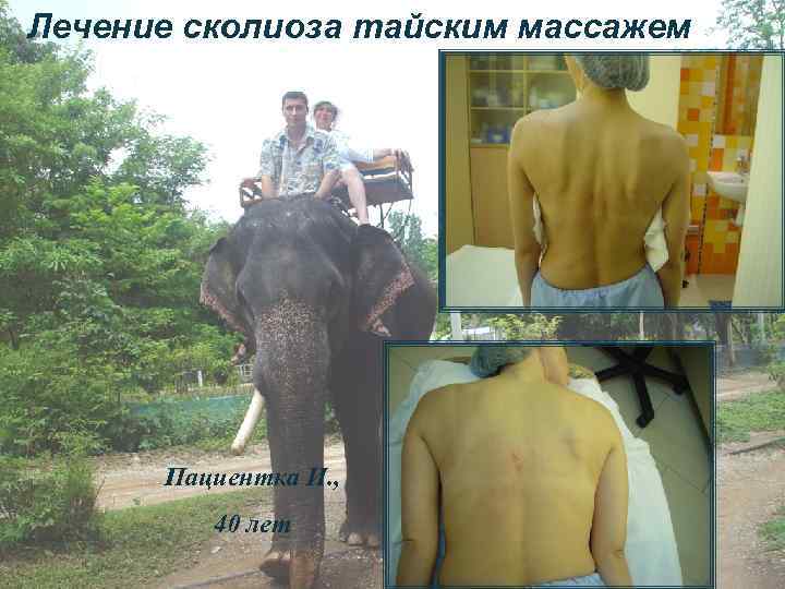 Лечение сколиоза тайским массажем Пациентка И. , 40 лет 