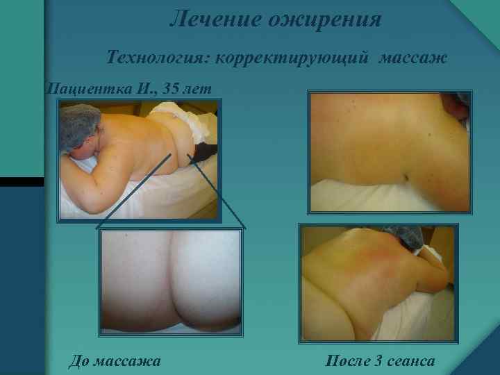 Лечение ожирения Технология: корректирующий массаж Пациентка И. , 35 лет До массажа После 3