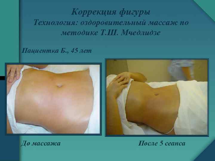 Коррекция фигуры Технология: оздоровительный массаж по методике Т. Ш. Мчедлидзе Пациентка Б. , 45
