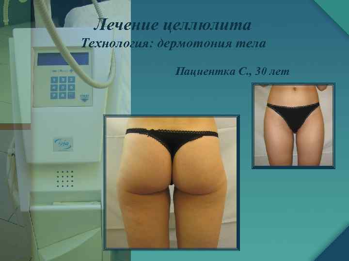 Лечение целлюлита Технология: дермотония тела Пациентка C. , 30 лет 