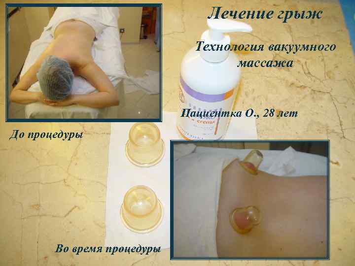 Лечение грыж Технология вакуумного массажа Пациентка О. , 28 лет До процедуры Во время