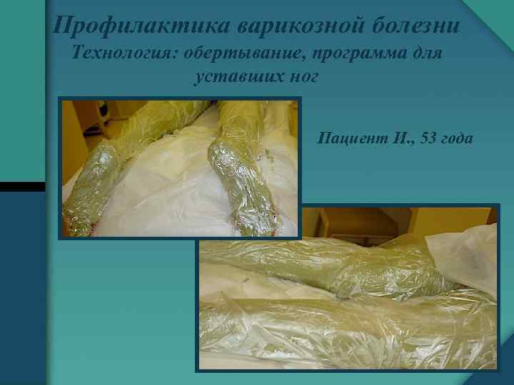 Профилактика варикозной болезни Технология: обертывание, программа для уставших ног Пациент И. , 53 года