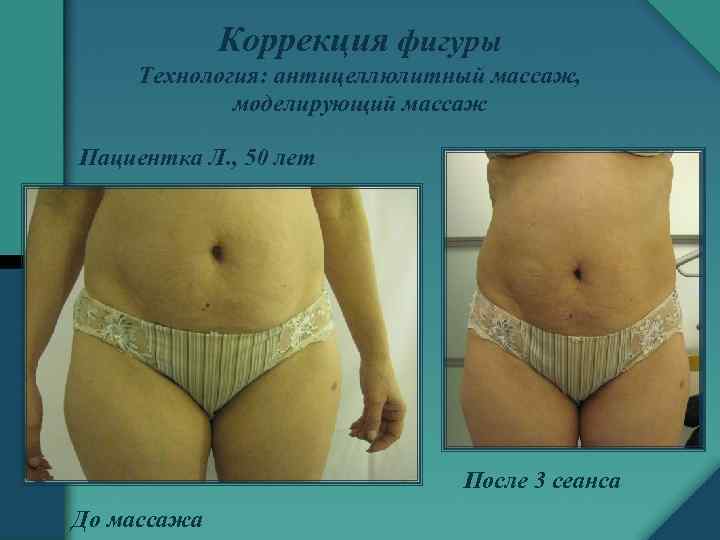 Коррекция фигуры Технология: антицеллюлитный массаж, моделирующий массаж Пациентка Л. , 50 лет После 3