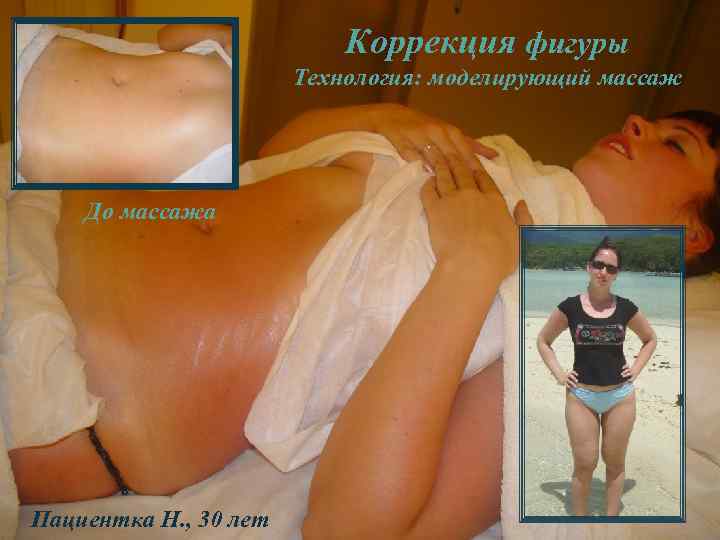 Коррекция фигуры Технология: моделирующий массаж До массажа Пациентка Н. , 30 лет 